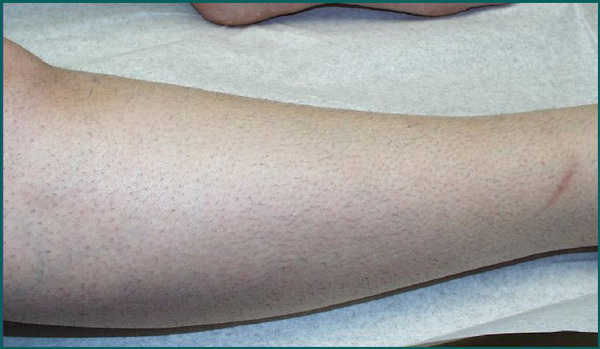 leg hair removal before and after