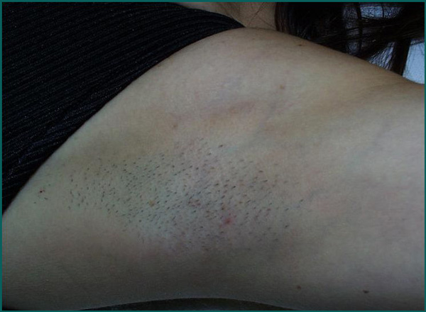 under arm hair removal before and after
