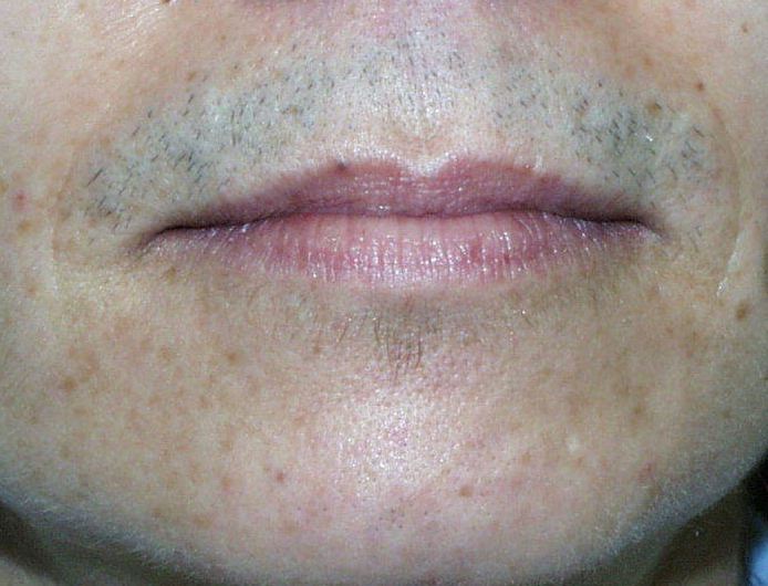 upper lip hair removal before and after