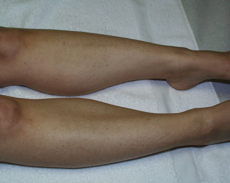 legs before laser hair removal
