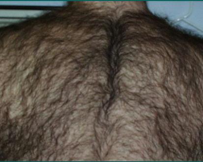 back hair before laser hair removal