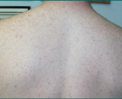 picture of back after laser hair removal